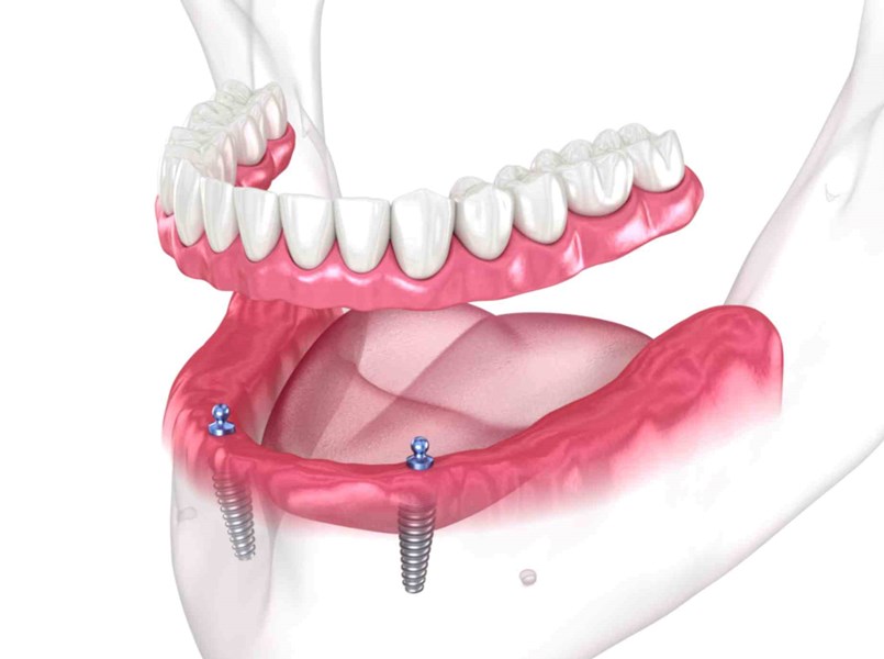 alveoli dentali