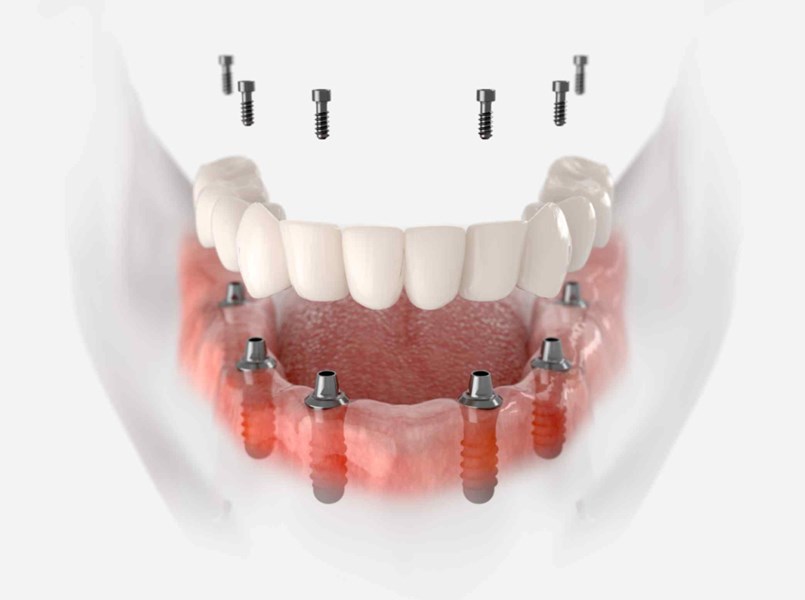 alveolo dentale