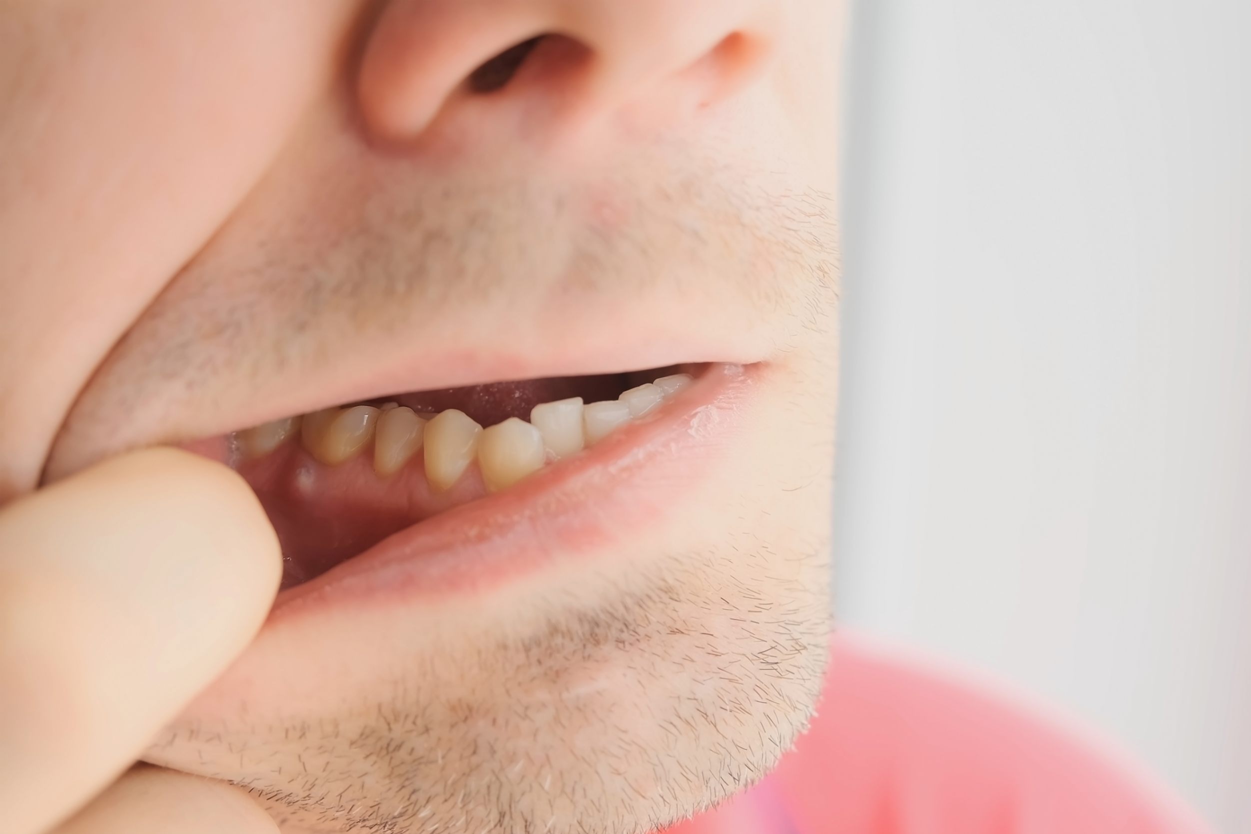 ascesso dentale
