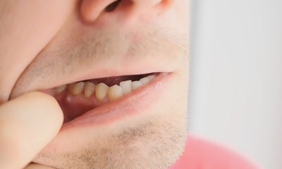 ascesso dentale