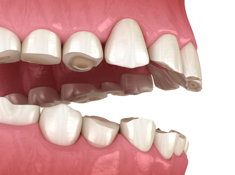 Denti consumati dal bruxismo