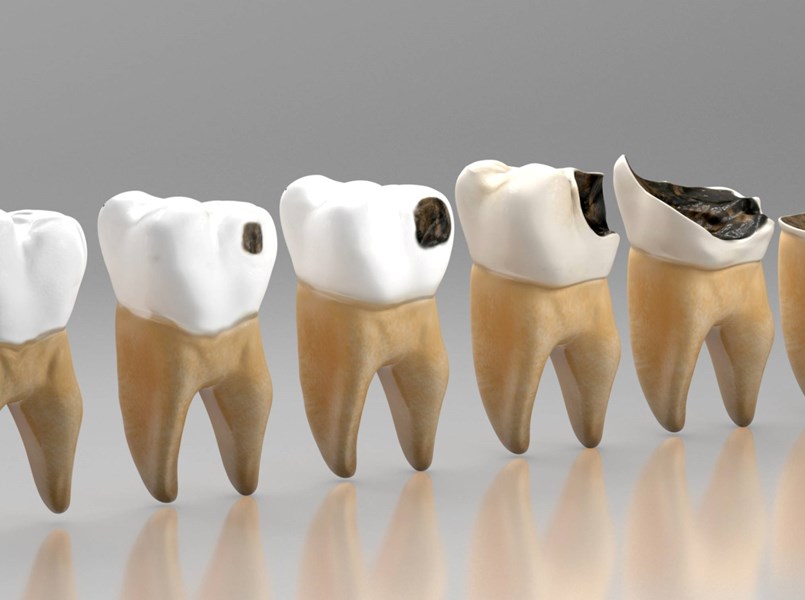 Dente con carie profonda prima dell'otturazione