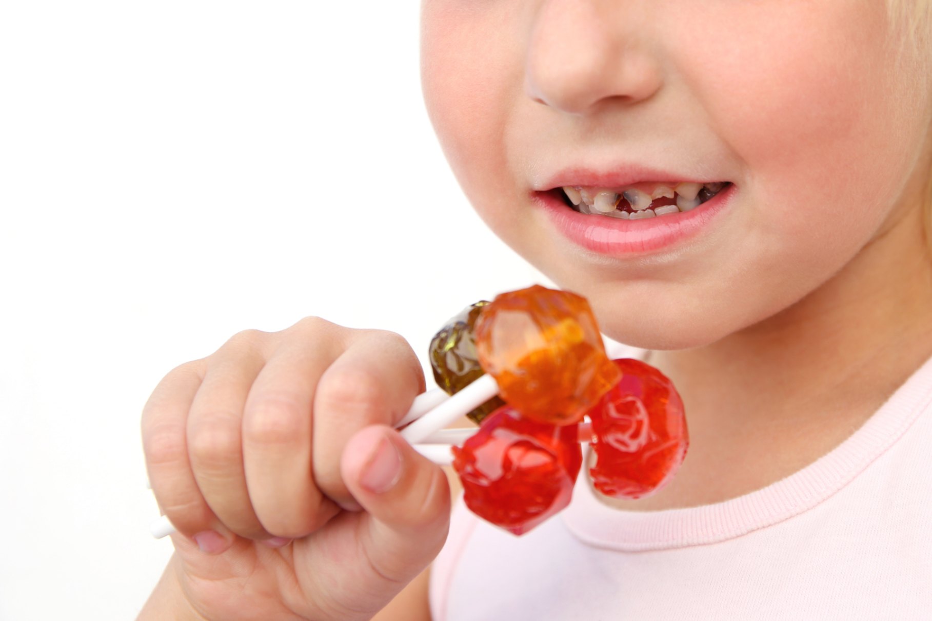 Carie visibile sulla superficie del dente