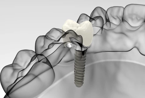 Corona dentale in ceramica