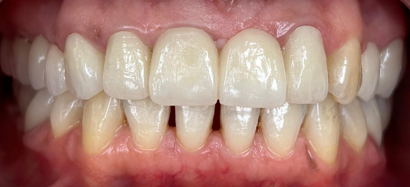 corona zirconio dentale su impianti dopo
