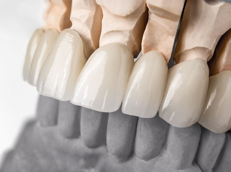 corone dentali