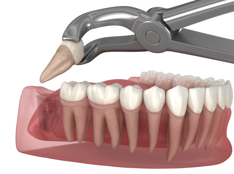 costo estrazione dente del giudizio