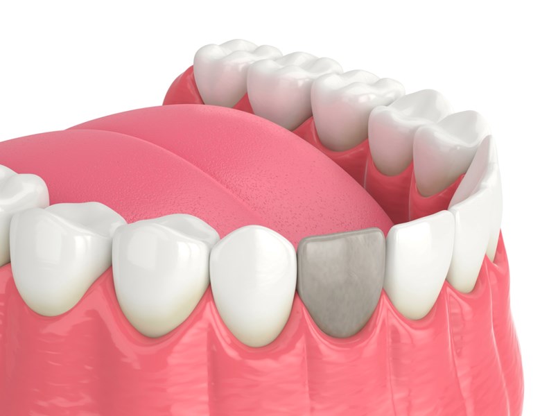 dente nero