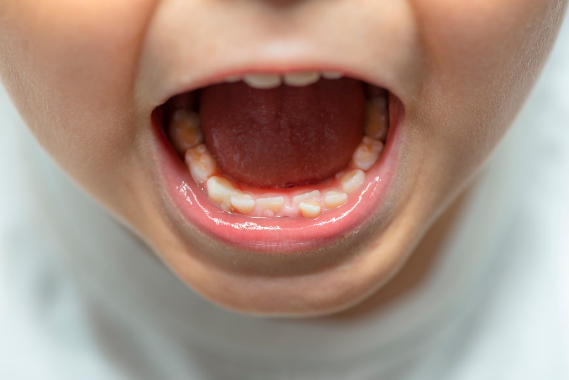 denti da latte