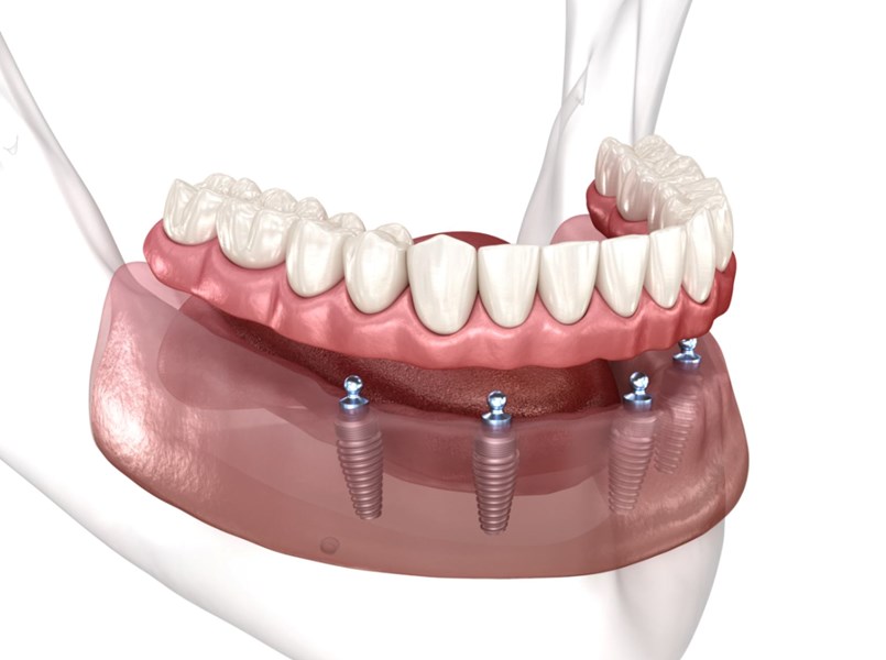 dentiera fissa