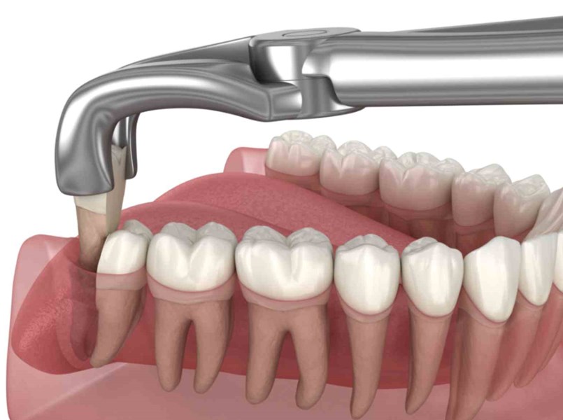 estrazione denti
