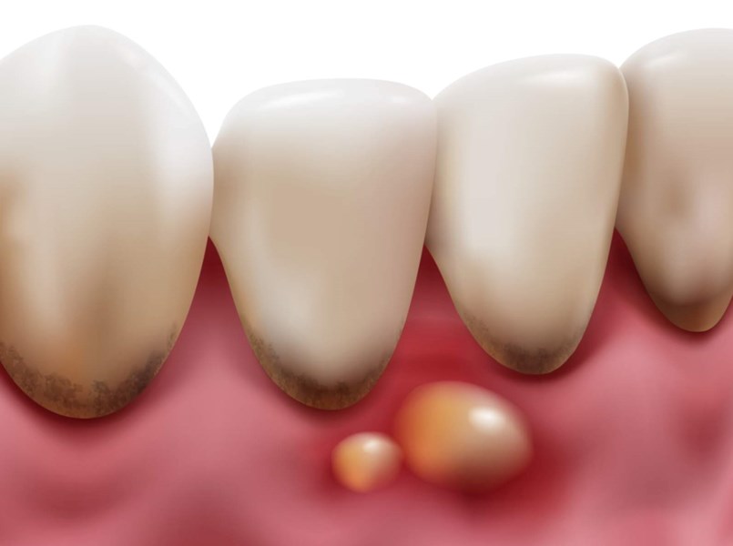 fistola dentale