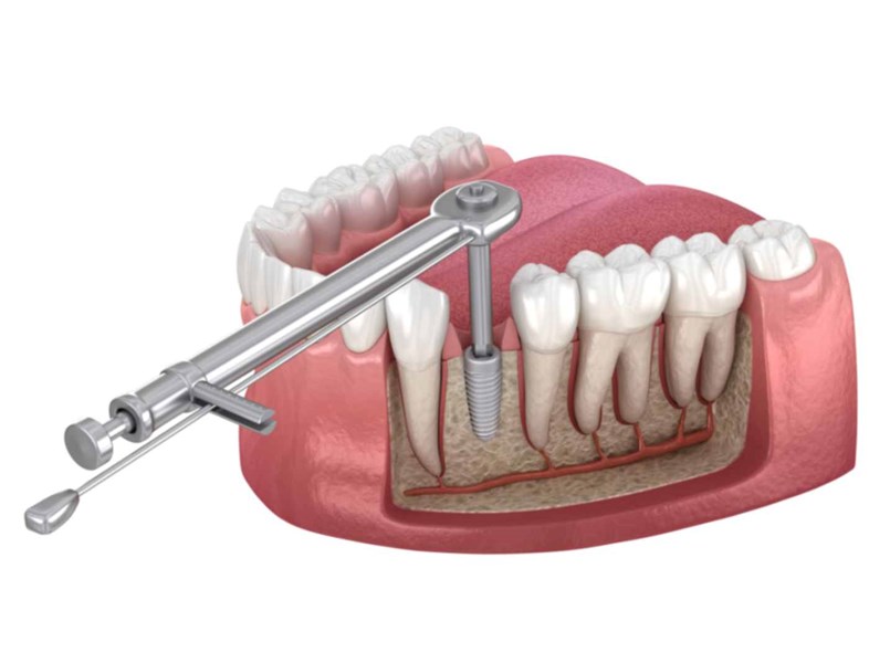 impianti dentali