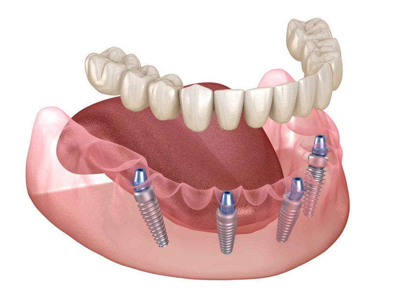 impianto dentale all on four