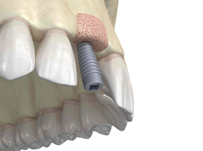 innesto osseo dentale