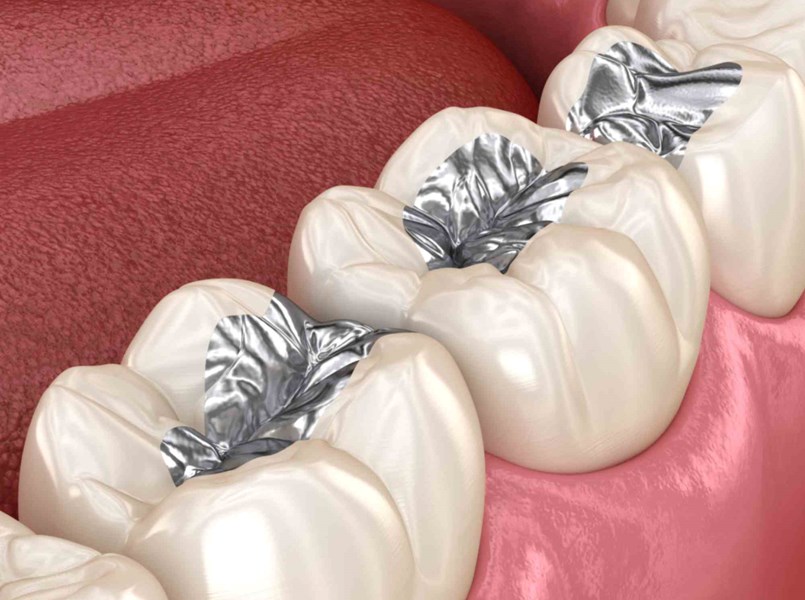 otturazione dente costo