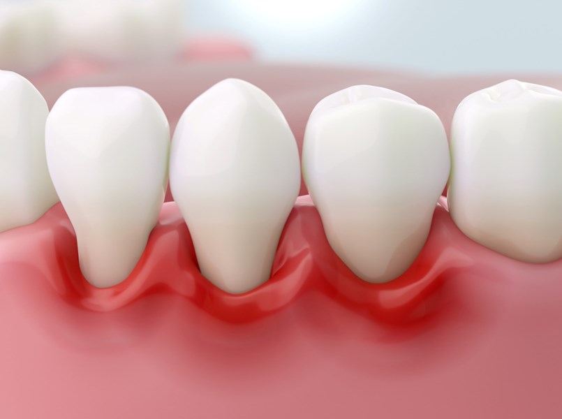 Radiografia di perdita ossea da piorrea
