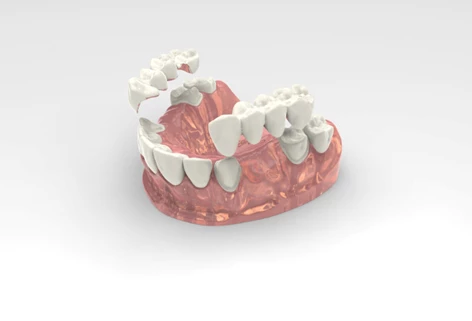 Ponte dentale su denti naturali