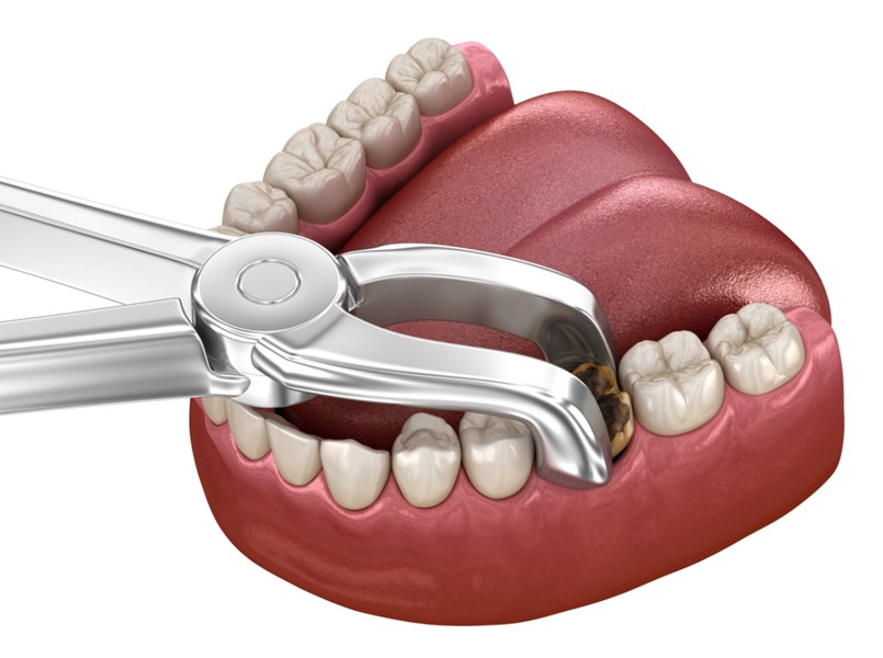 Impacco freddo dopo l'estrazione dentale