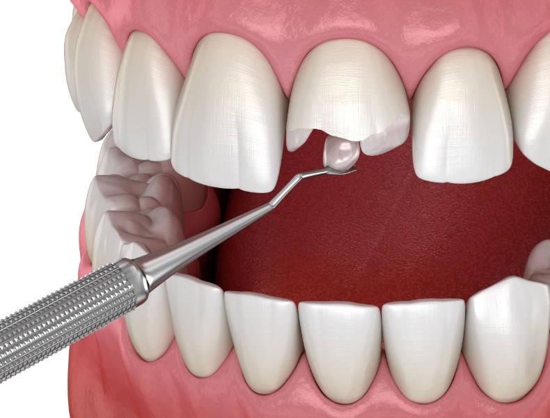 ricostruzione dente rotto