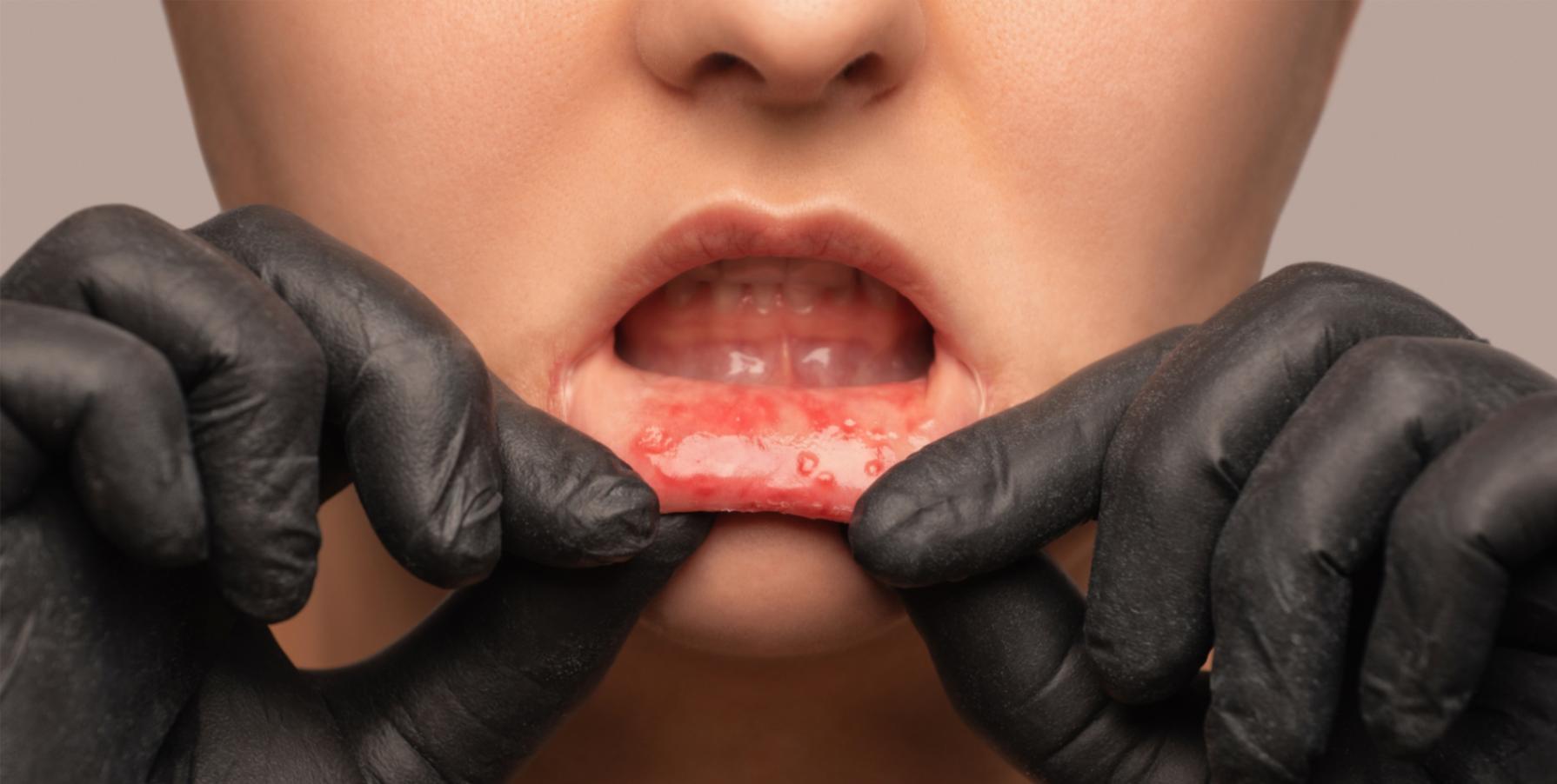 /dentista/stomatite.jpg