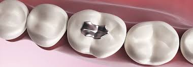 Otturazioni dentali